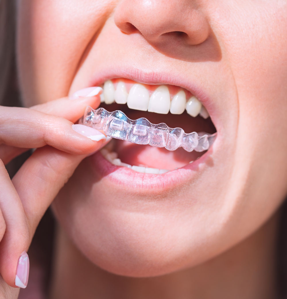 http://Comfortable%20clear%20aligners